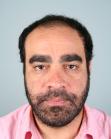 Before Hair Transplant &nbsp;2 Sessions (Areas)